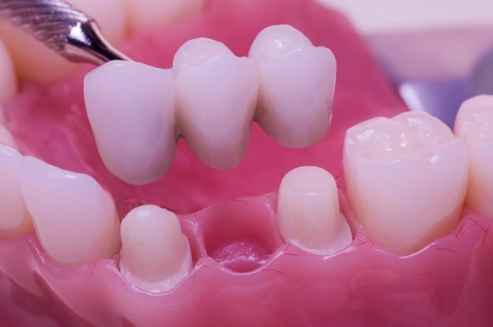 4 Types of Dental Bridges: Which One Is Right for You?