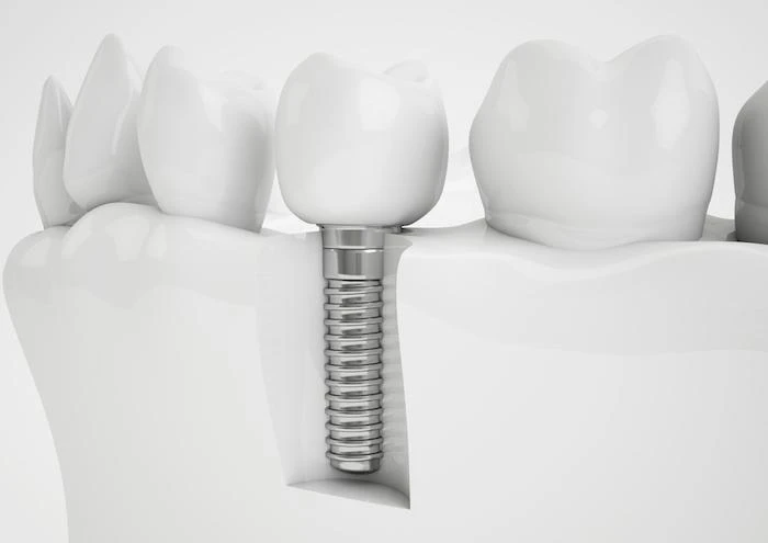 5 Reasons Dental Implants Are Superior to Other Teeth Replacement Options